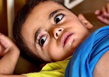 Kelaparan dan Penyakit Kulit Menyerang Anak-Anak Gaza di Kamp Pengungsian