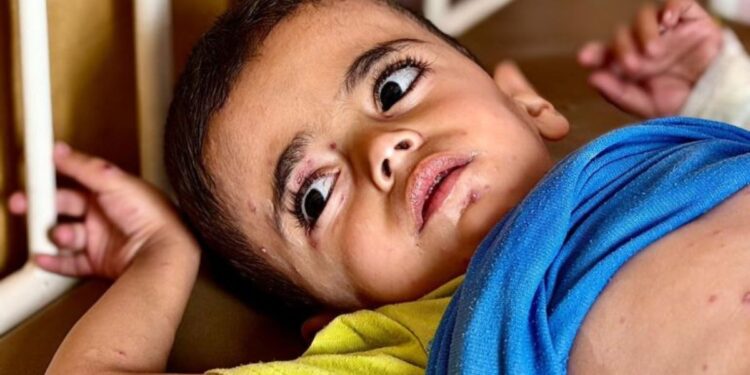Kelaparan dan Penyakit Kulit Menyerang Anak-Anak Gaza di Kamp Pengungsian